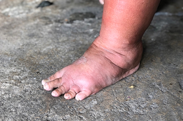 the-link-between-swollen-feet-and-alcohol